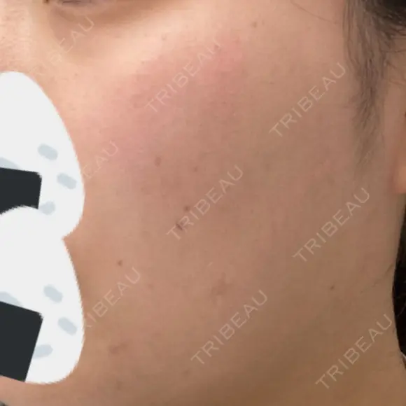 ルメッカ Belle Via Skin Clinic AFTER メイン用