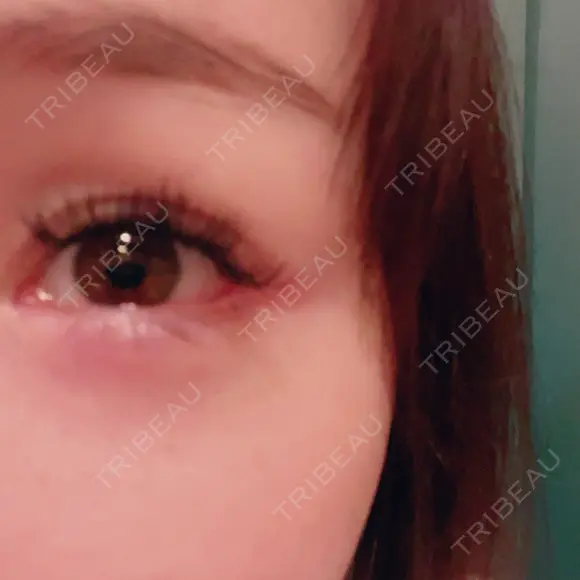 糸リフト / 目尻切開 / タレ目形成・グラマラスライン（切開） / ボトックス（あご） / ヒアルロン酸注入（あご） / ヒアルロン酸注入（鼻翼基部） Tokyo Tensei Clinic 新宿院 DAY 12 メイン用