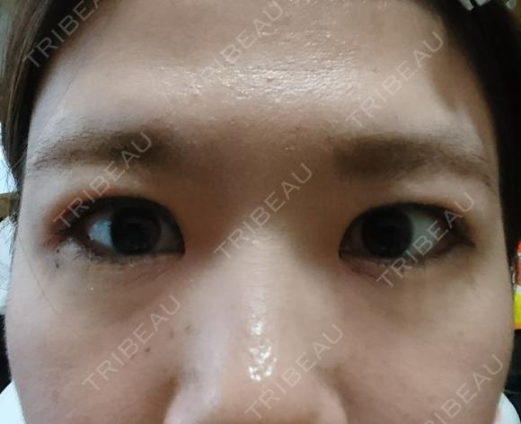 二重埋没 湘南美容クリニック 鹿児島院 AFTER メイン用