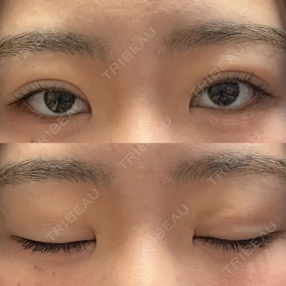 二重埋没 WOM CLINIC GINZA （ワム クリニック ギンザ） DAY 6 メイン用