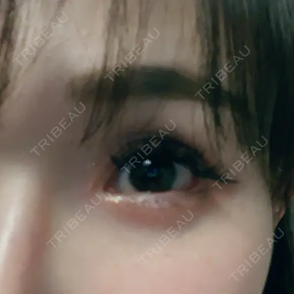 糸リフト / 目尻切開 / タレ目形成・グラマラスライン（切開） / ボトックス（あご） / ヒアルロン酸注入（あご） / ヒアルロン酸注入（鼻翼基部） Tokyo Tensei Clinic 新宿院 DAY 13 メイン用