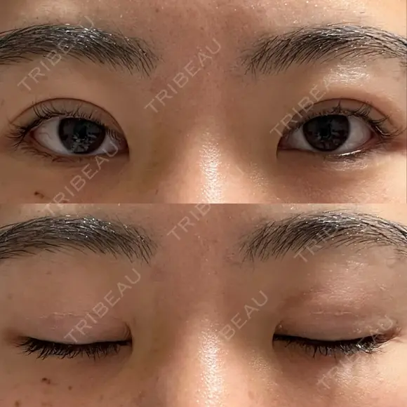 二重埋没 WOM CLINIC GINZA （ワム クリニック ギンザ） DAY 7 メイン用