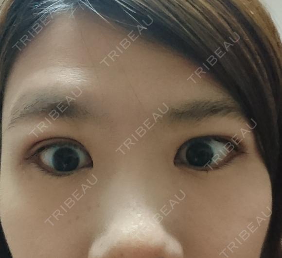 二重埋没 湘南美容クリニック 鹿児島院 DAY 8 メイン用