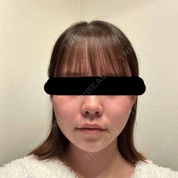 脂肪吸引（顔） / 脂肪吸引注射（顔） SEA CLINIC（シークリニック） DAY 106 メイン用