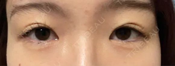 二重埋没 / 上まぶたの脂肪取り THE FIRST CLINIC 多摩センター院 DAY 0 メイン用