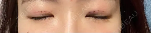 二重埋没 / 上まぶたの脂肪取り THE FIRST CLINIC 多摩センター院 DAY 0 メイン用