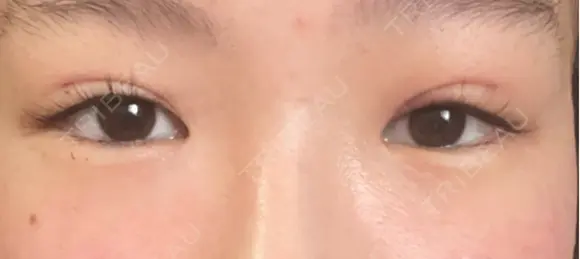 二重埋没 / 上まぶたの脂肪取り THE FIRST CLINIC 多摩センター院 AFTER メイン用