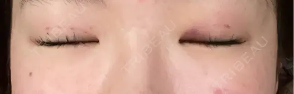 二重埋没 / 上まぶたの脂肪取り THE FIRST CLINIC 多摩センター院 DAY 1 メイン用