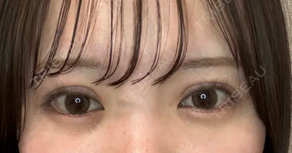 二重埋没 湘南美容クリニック 池袋東口院 DAY 7 メイン用