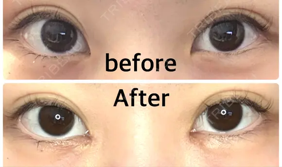 目頭切開 9BeautyClinic AFTER メイン用