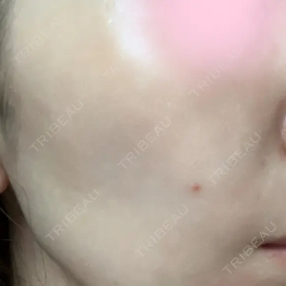 ピーリング（ニキビ・毛穴） KIMI CLINIC 形成・美容外科 DAY 0 メイン用