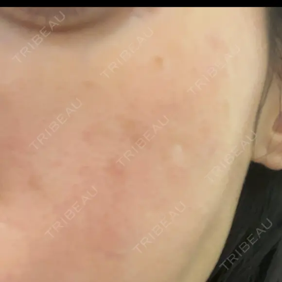 ルメッカ ルラ美容クリニック銀座院 DAY 0 メイン用