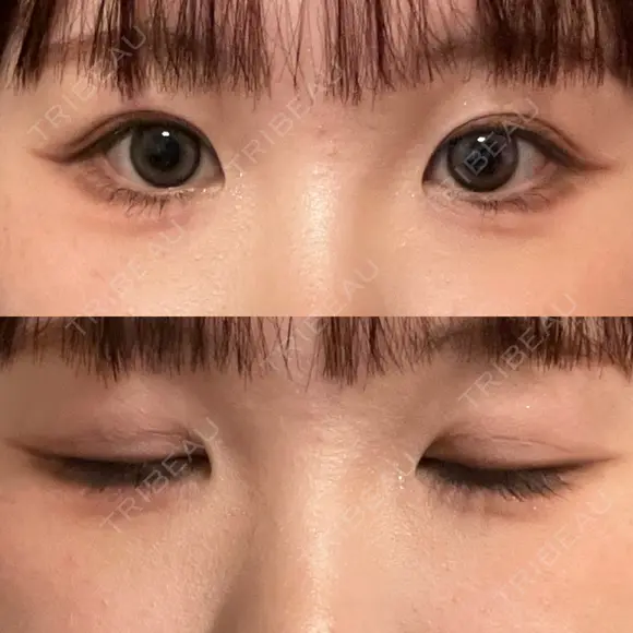二重切開 / 眼瞼下垂（切開） / 上まぶたたるみ取り ユア美容クリニック 福岡院 AFTER メイン用