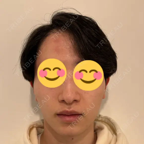 糸リフト / 脂肪吸引（顔） / 輪郭修正 / メーラーファット除去 / 脂肪吸引注射（顔） / ヒアルロン酸注入（あご） / ボトックス（エラ・小顔） SEA CLINIC（シークリニック） DAY 47 メイン用