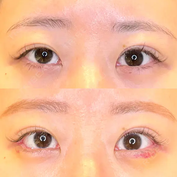 目尻切開 / タレ目形成・グラマラスライン（埋没） / 美容点滴・美容注射（美肌） LOUIS CLINIC 二子玉川院【ルイクリニック】 DAY 7 メイン用