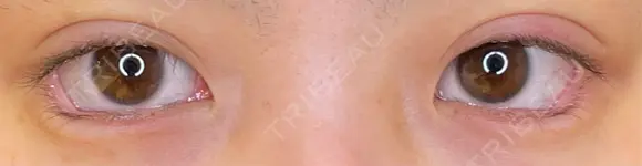 二重埋没 / タレ目形成・グラマラスライン（埋没） LOUIS CLINIC 二子玉川院【ルイクリニック】 DAY 0 メイン用