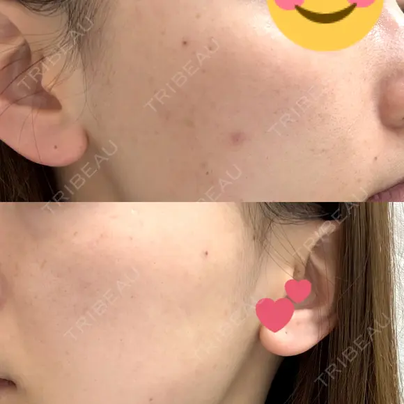 ピーリング（ニキビ・毛穴） / ルメッカ WellnessPlus Clinic 【ウェルネスプラスクリニック】 DAY 0 メイン用