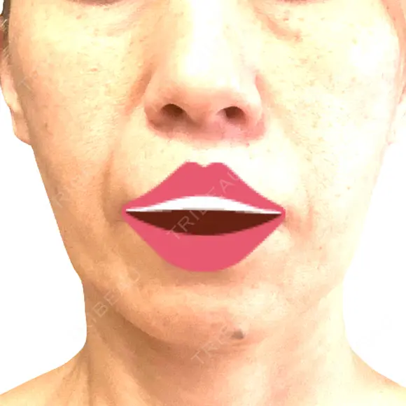 ボトックス（エラ・小顔） / ヒアルロン酸注入（頬） 新未来クリニック DAY 22 メイン用