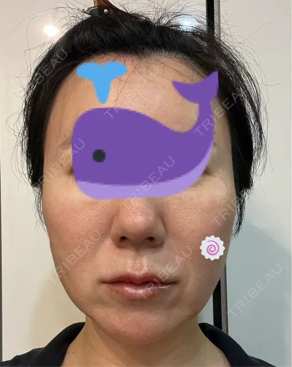 糸リフト Olino美容外科・美容皮膚科 DAY 14 メイン用