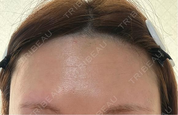 医療脱毛（顔） Jスキンクリニック 【J-SKIN clinic】 AFTER メイン用
