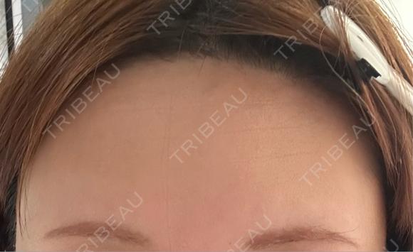 医療脱毛（顔） Jスキンクリニック 【J-SKIN clinic】 DAY 23 メイン用