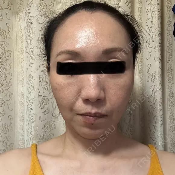 糸リフト / クマ治療 / 下まぶたの脂肪取り / 脂肪注入（肌） / こめかみ形成 / 脂肪注入（目の下） / ボトックス（あご） / ボトックス（首） 東京シンデレラ美容外科 池袋院 DAY 8 メイン用