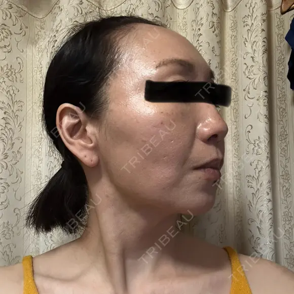 糸リフト / クマ治療 / 下まぶたの脂肪取り / 脂肪注入（肌） / こめかみ形成 / 脂肪注入（目の下） / ボトックス（あご） / ボトックス（首） 東京シンデレラ美容外科 池袋院 DAY 8 メイン用