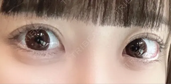 タレ目形成・グラマラスライン（埋没） LOUIS CLINIC 二子玉川院【ルイクリニック】 AFTER メイン用