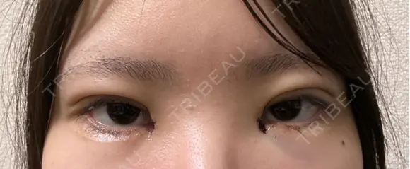 二重埋没 / 目頭切開 / 上まぶたの脂肪取り 9BeautyClinic DAY 2 メイン用