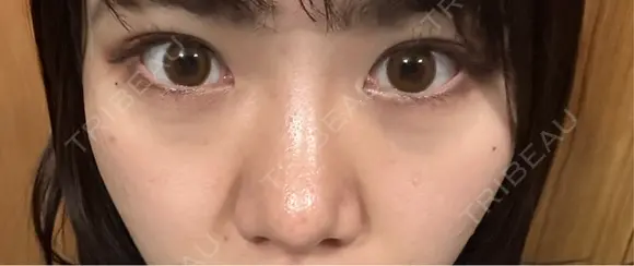 二重埋没 / 隆鼻術 / 鼻尖形成（切開） / 小鼻縮小（切開） / 軟骨移植 R Beauty CLINIC 名古屋院 DAY 120 メイン用