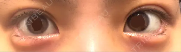 二重埋没 / タレ目形成・グラマラスライン（埋没） LOUIS CLINIC 二子玉川院【ルイクリニック】 AFTER メイン用