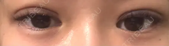 二重埋没 9BeautyClinic DAY 1 メイン用