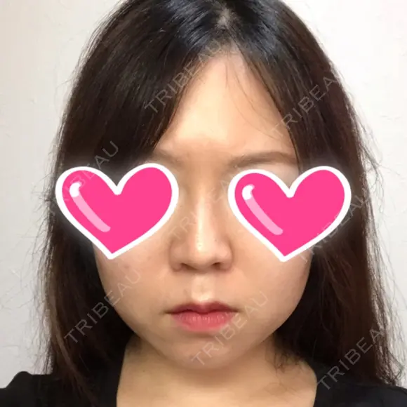 隆鼻術 / 鼻尖形成（切開） / 鼻中隔延長（切開） / 小鼻縮小（切開） ザ・プラス美容外科 DAY 180 メイン用