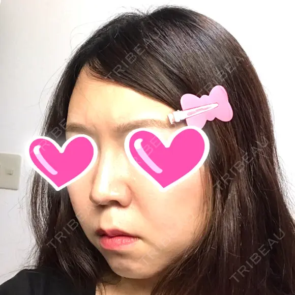 隆鼻術 / 鼻尖形成（切開） / 鼻中隔延長（切開） / 小鼻縮小（切開） ザ・プラス美容外科 DAY 180 メイン用