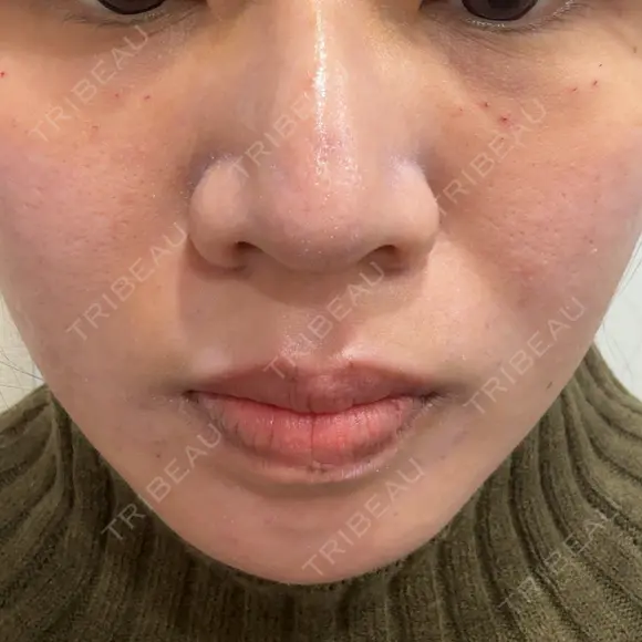 ベビーコラーゲン しのぶ皮膚科 DAY 0 メイン用