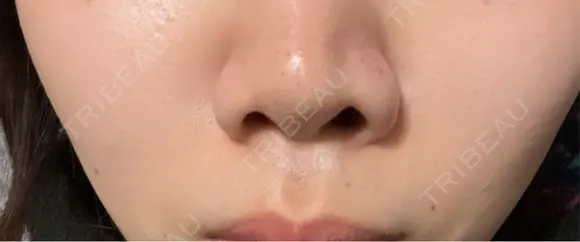 小鼻縮小（非切開） 形成外科と美容外科のクリニック池袋 DAY 0 メイン用