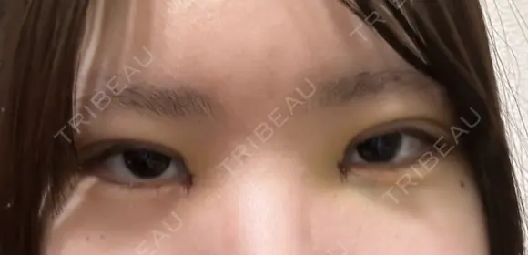 二重埋没 / 目頭切開 / 上まぶたの脂肪取り 9BeautyClinic DAY 3 メイン用
