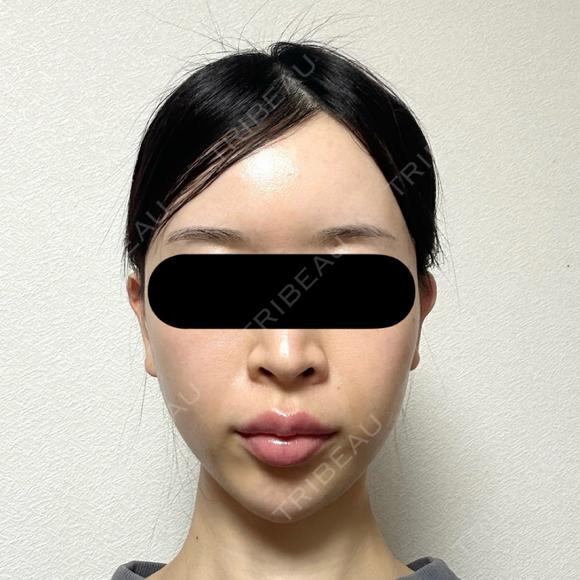 糸リフト / バッカルファット除去 / 脂肪吸引（顔） / ジョールファット除去 / ヒアルロン酸注入（額） / ヒアルロン酸注入（頬） BLINC CLINIC （ブリンク クリニック） DAY 30 メイン用