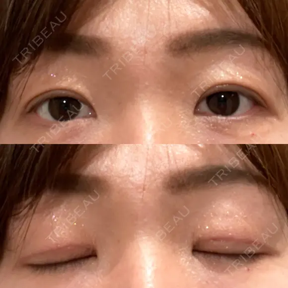 二重切開 / 上まぶたたるみ取り / 上まぶたの脂肪取り VIDA BEAUTY CLINIC AFTER メイン用