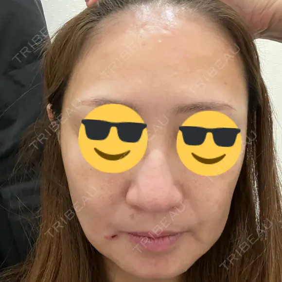 ボトックス（額） / ピーリング（ニキビ・毛穴） / イオン導入 CHARIS BEAUTY CLINIC AFTER メイン用