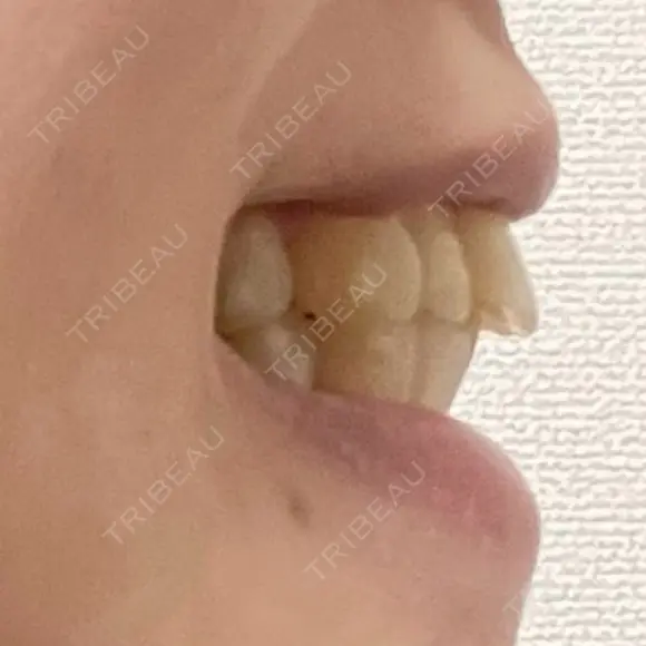 矯正（マウスピース） SF六本木東京 dental orthodontics DAY 71 メイン用