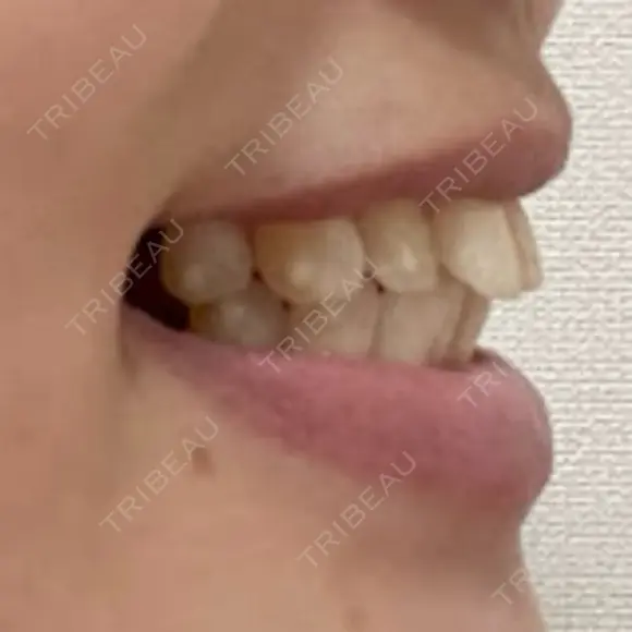 矯正（マウスピース） SF六本木東京 dental orthodontics DAY 135 メイン用