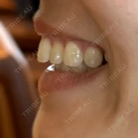 矯正（マウスピース） SF六本木東京 dental orthodontics DAY 455 メイン用