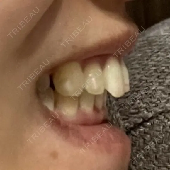 矯正（マウスピース） SF六本木東京 dental orthodontics DAY 401 メイン用