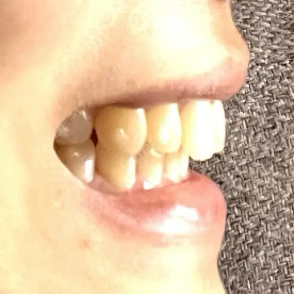 矯正（マウスピース） SF六本木東京 dental orthodontics AFTER メイン用