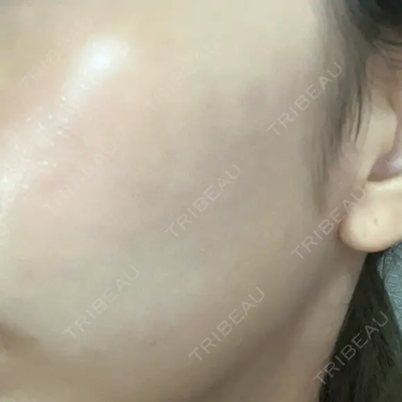 ピーリング（ニキビ・毛穴） KIMI CLINIC 形成・美容外科 AFTER メイン用