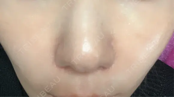 ヒアルロン酸注入（鼻翼基部） KIMI CLINIC 形成・美容外科 AFTER メイン用