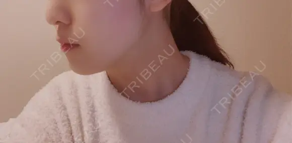 糸リフト / バッカルファット除去 / 脂肪吸引（顔） EMMA CLINIC（エマクリニック） DAY 430 メイン用