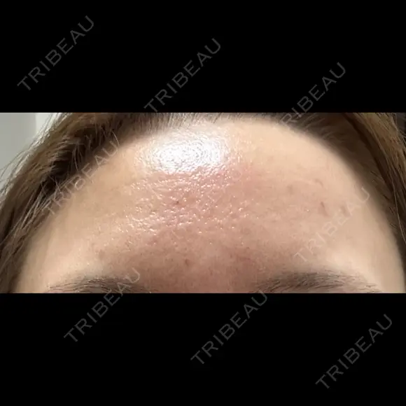 マイクロボトックス BAO CLINIC 心斎橋院 DAY 0 メイン用