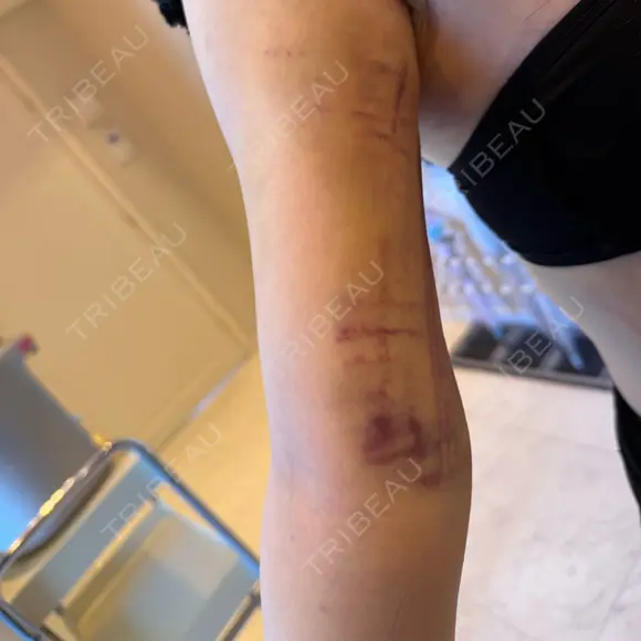 脂肪吸引（顔） / 脂肪吸引（二の腕） / 脂肪吸引（脚） / 脂肪吸引（お腹） / 脂肪吸引（お尻） / 脂肪吸引（腰） / 脂肪吸引（背中） / 脂肪吸引（肩） ヴェルトラクリニック 新宿院 DAY 2 メイン用